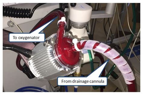 ecmo pump centrifugal|ecmo flow chart.